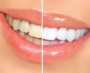 Teeth whitening Grand Rapids MI cosmetic dentists