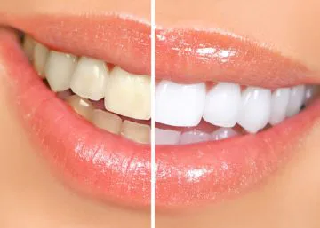 Teeth whitening Grand Rapids MI cosmetic dentists